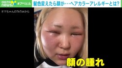 ヘアカラーで顔がパンパンに！？ 「顔と頭皮、全部かゆい！」症状と対策は？