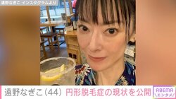 「私の愛しのおハゲちゃん」遠野なぎこ、円形脱毛症の現状を報告 前向きな投稿に多くの反響「心配」「生えてきてますね」