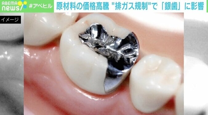 排ガス規制が「銀歯」に影響、原材料のパラジウムが高騰 「100万円前後の持ち出しも…」 1枚目