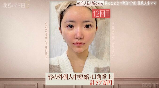 【写真・画像】「整形総額1000万円」19歳から12回繰り返した“顔面課金”の全記録「顔の骨を削り、鼻をフル整形」34歳美女が“お人形フェイス”を手に入れるまで　2枚目