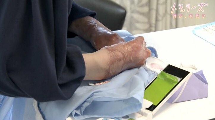 「泣いていても元には戻れない」交通事故で全身の60%に火傷を負った母、子どもたちとの距離が縮まるまで