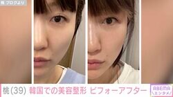 桃、韓国で3月に受けた美容整形ビフォーアフター「ほうれい線全然違う！」「美人さん発見しました」と反響