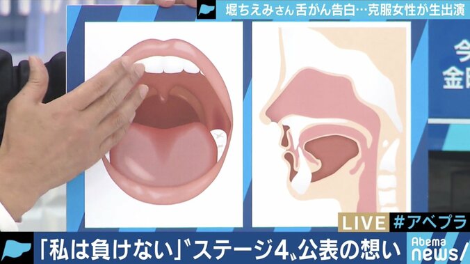 堀ちえみが「舌がん」告白…専門医「２週間以上続く口内炎は受診を」 2枚目