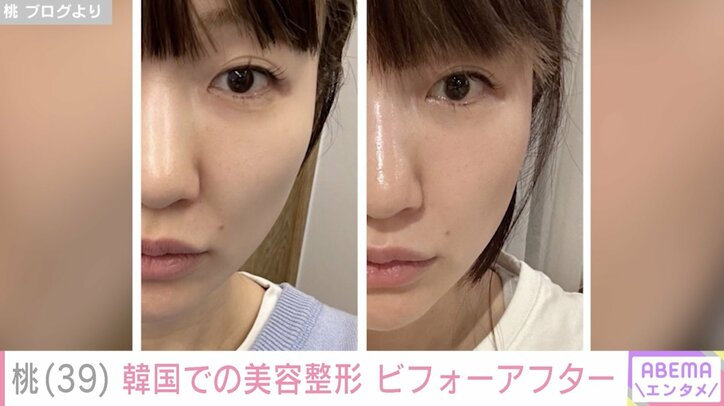 【写真・画像】あいのり桃「韓国での美容医療の成果、出てる？」ダウンタイム4日目と2週間後を公開　1枚目