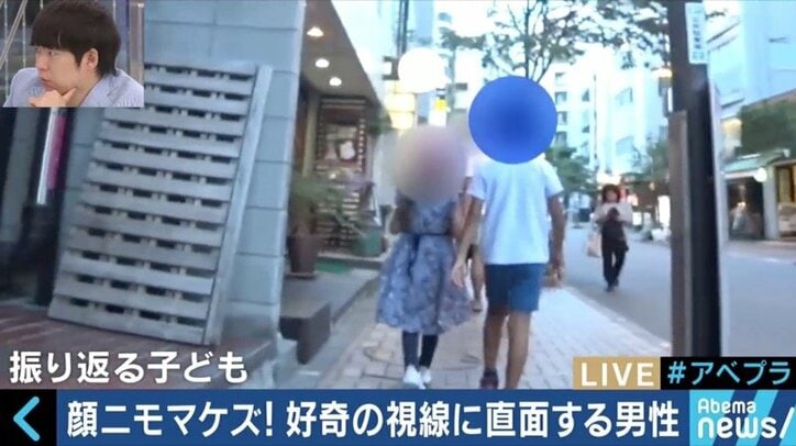 「ワンダー 君は太陽」で描かれたトリーチャーコリンズ症候群　“当事者”石田祐貴さんが視線を浴びながらも街を歩く理由