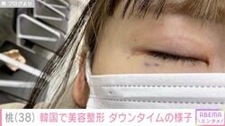 あいのり桃、韓国で美容整形 ダウンタイムの様子公開「あしたになったらまた変わるのか？」
