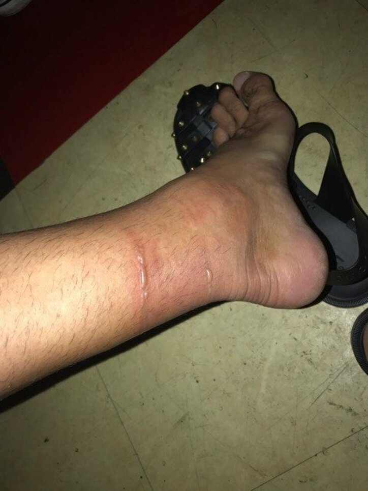 山田親太朗、ハブクラゲに刺されて腫れた左足を公開「痛いです…」 話題 ABEMA TIMES 山田親太朗、ハブクラゲに刺されて腫れた左足を公開「痛いです…」 話題 ABEMA TIMES