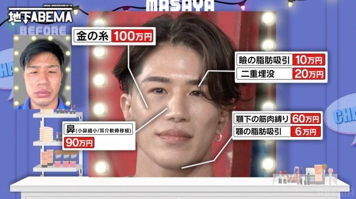 【写真・画像】整形費用300万円で“岩田剛典”になったイケメン、効果絶大の“金の糸”施術を紹介　1枚目