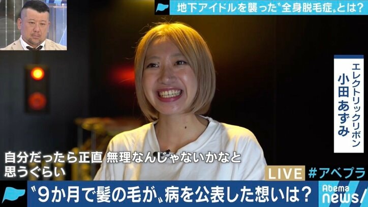「頭が丸くても続けたい」…全身脱毛症アイドル、告白の裏にファンの後押しも