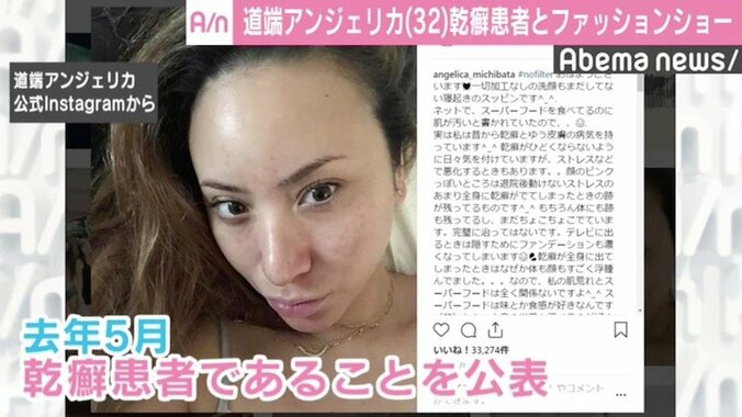 道端アンジェリカ、“乾癬”告白の理由は「ただ悔しかった」 2枚目