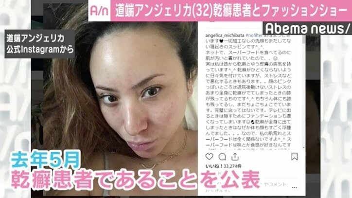 道端アンジェリカ、“乾癬”告白の理由は「ただ悔しかった」