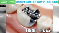 “排ガス規制”で「銀歯」がなくなる?