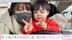 あいのり桃、左目の眼瞼下垂症手術をした2歳・次男の“右目を心配”「癖が残っちゃって」