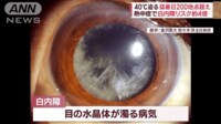 【映像】40度迫る猛暑日200地点超え 熱中症で白内障リスク約4倍