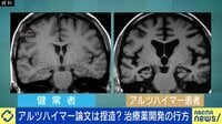 アルツハイマー病論文に捏造疑惑…治療薬開発に影響は？不正なぜ起きる