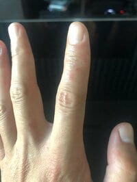 狩野英孝『手荒れ』