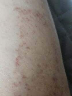  山田美保子氏、帯状疱疹を疑われた酷い症状「辛いですね」「お大事に」の声 