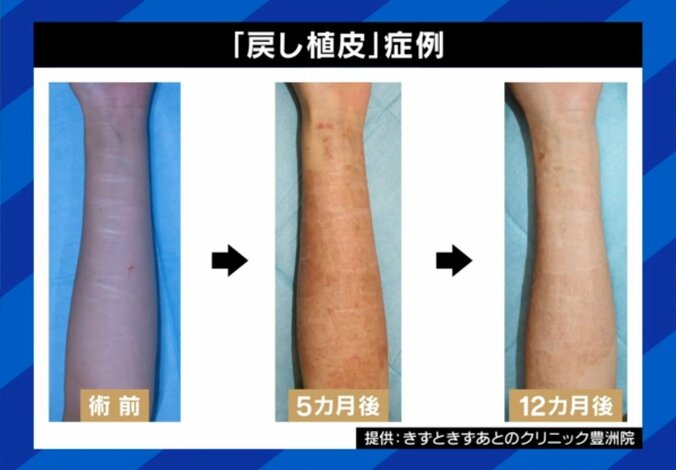 リスカ跡手術 術前・術後の比較（実際の様子）