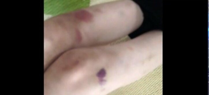 ”白血病サバイバー”のタレント友寄蓮、池江璃花子選手の公表受け献血や骨髄バンク登録を呼びかけ