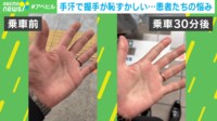 【映像】「画期的だった」 手掌多汗症の患者を救う“治療薬”