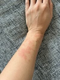 内山琴『今更腫れてきた！！！』