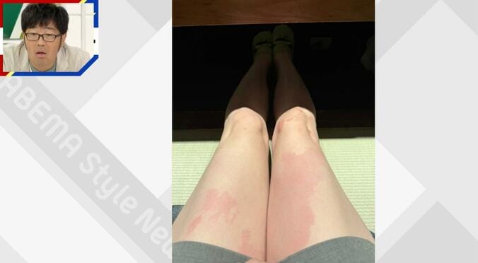 飲酒で体がまだらに赤く変色