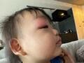 あいのり・桃、病院を訪れるも目の腫れが全く治まらない次男「どーなってるの?!って感じ」