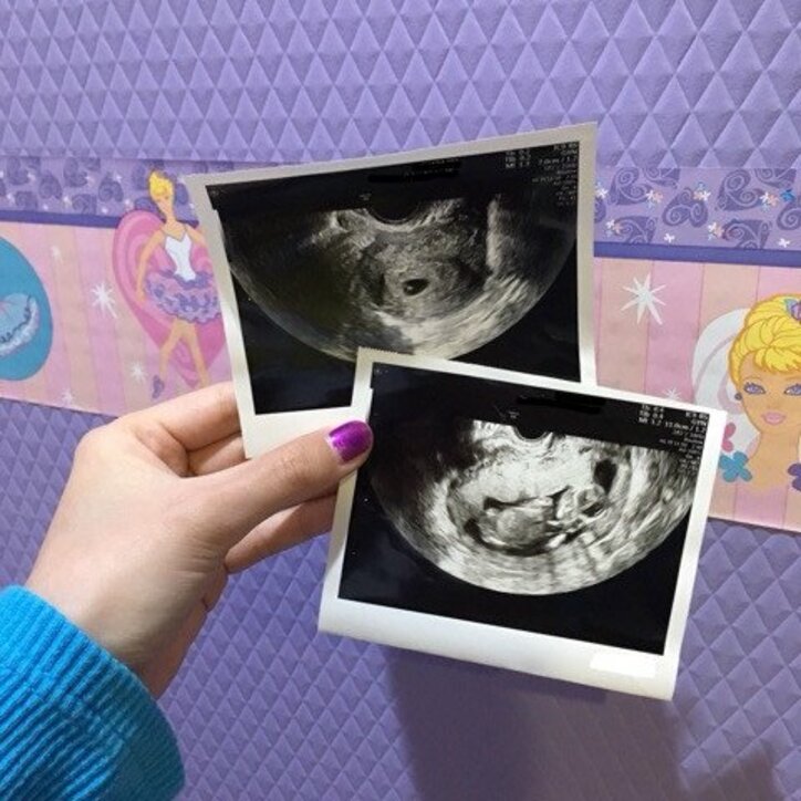 写真 妊娠5ヶ月のぺこ エコー写真を公開 とってもとっても愛おしい 話題 Abema Times