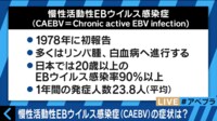 声優・松来未祐の命奪った難病「CAEBV」とは？　専門家が解説