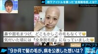 AbemaPrime【平日よる9時～生放送】 - 企画 - 「ウィッグで心が救われた」全身の毛が抜ける"全身脱毛症"と向き合うアイドル | 動画視聴は【Abemaビデオ(AbemaTV)】