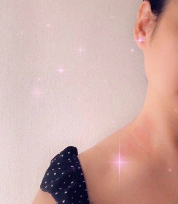 だいたひかる、夏に向けて気を付けたいアレルギー「痒くなって赤くなるという…」