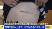 女性だけでない“男性乳がん”、発症者が語る戸惑いと早期発見の重要性 医師「乳腺があるからなる、と知って」 セルフチェック方法は?