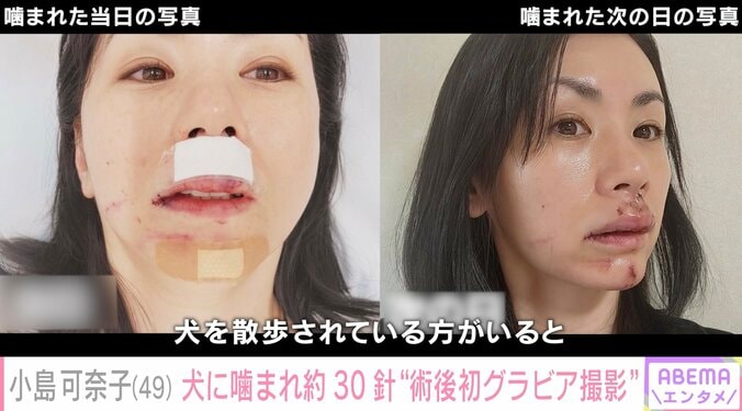 30針縫った後の小島可奈子