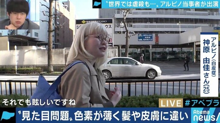 生まれつき色素が薄いアルビノ当事者の苦しみ「カラーコードに合わないから‥」バイト・就職を断られるケースも