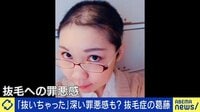 「私の場合は笑って欲しい」抜毛症当事者の葛藤とは