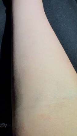  だいたひかる、今までで一番重症な蜂窩織炎の症状「細菌が全身にまわると、命にかかわる敗血症に」 