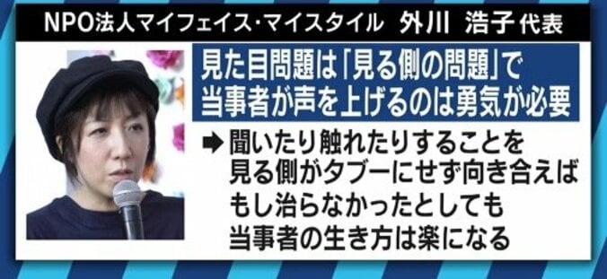 患者が告白「結婚は難しいと言われショックを受けた」　道端アンジェリカも誤解と偏見に苦しむ「乾癬」とは 12枚目