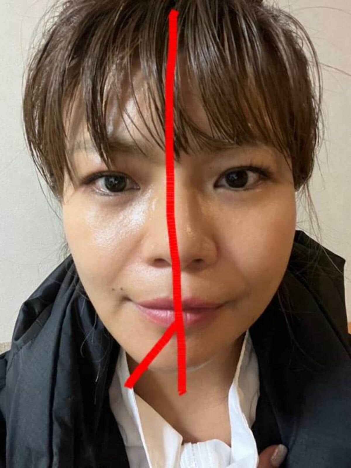 あいのりクロ 整形