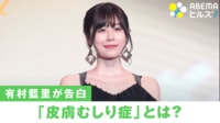 有村藍里「皮膚むしり症」を告白