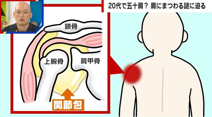 【写真・画像】20代で五十肩に？老化が原因では無かった？医師「なぜ起きるか全くの謎」「原因がわかればノーベル賞級」 肩にまつわる謎に迫る　3枚目