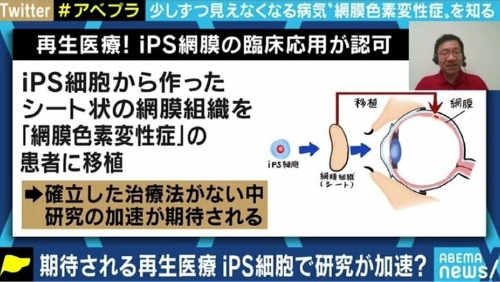 少しずつ奪われる視力、視野…“見えることが前提の社会”で悩む5万人の網膜色素変性症患者たち