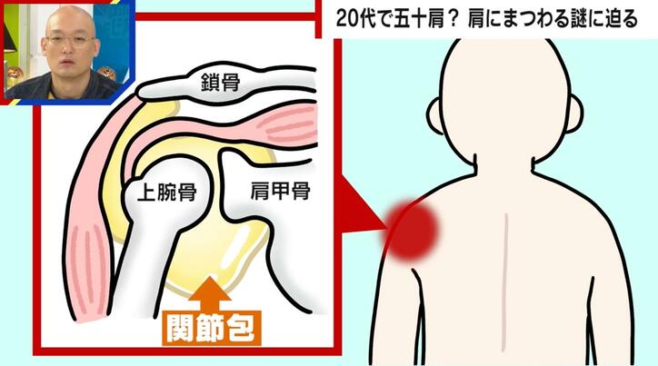 【写真・画像】20代で五十肩に?老化が原因では無かった?医師「なぜ起きるか全くの謎」「原因がわかればノーベル賞級」 肩にまつわる謎に迫る 3枚目