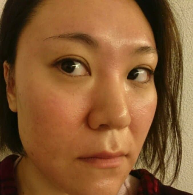 バービー、特殊レーザーで肌に変化「ツルっとしてクレーターが浅くなってる」 1枚目