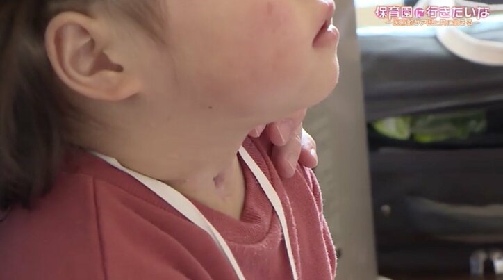 毎年1000人ペースで増える「医療的ケア児」、保育園入園のハードルに苦悩する親たち