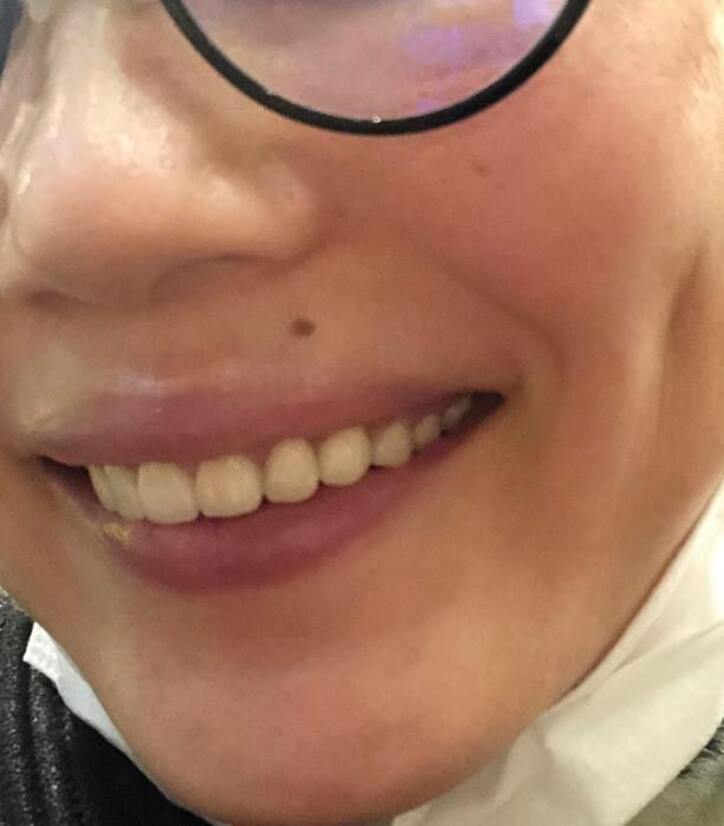  平野ノラ、前歯をセラミック治療したことを報告「自然じゃないですか？」 