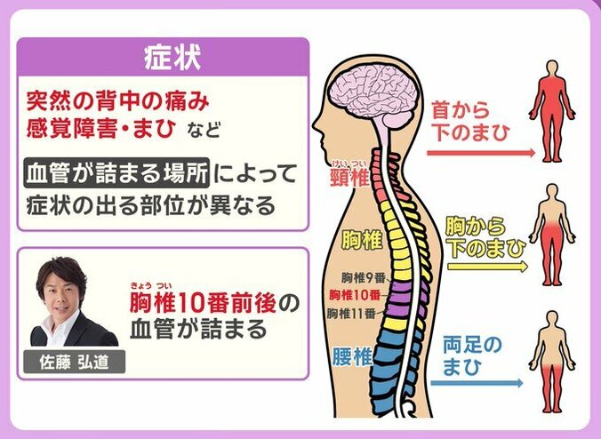 脊髄梗塞の症状