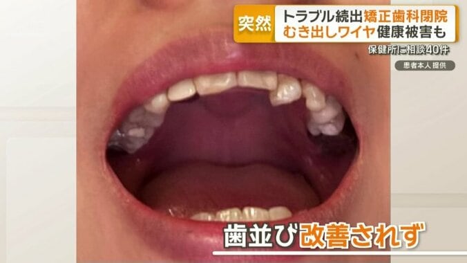 歯並び改善されず