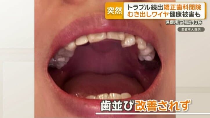 歯並び改善されず