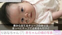 先天性疾患による低身長・りおなちゃん（7）「鼻から胃に通したチューブで栄養をとっていました」生後間もない写真を公開