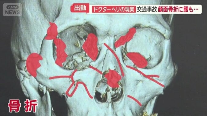 顔面の複数箇所で骨折が判明